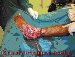 CRUSH INJURIES FOOT AND ANKLE