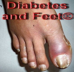 DIABETES AND YOUR FEET