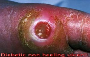 DIABETIC FOOT ULCERS