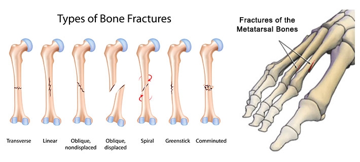 TOE AND FOREFOOT FRACTURES