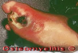 OSTEOMYELITIS