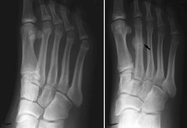 STRESS FRACTURES OF THE FOOT AND ANKLE
