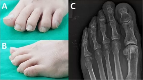 Congenitally short toes