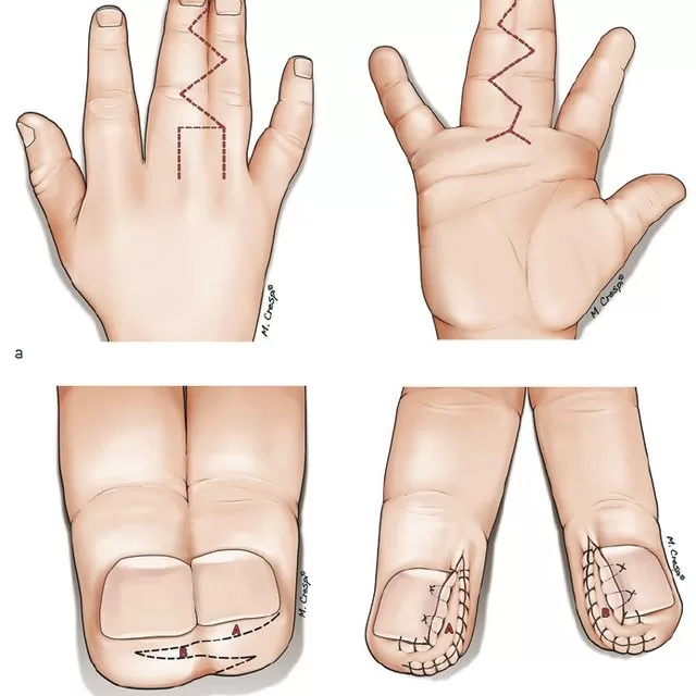 Syndactyly