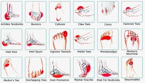 Common problems of Foot