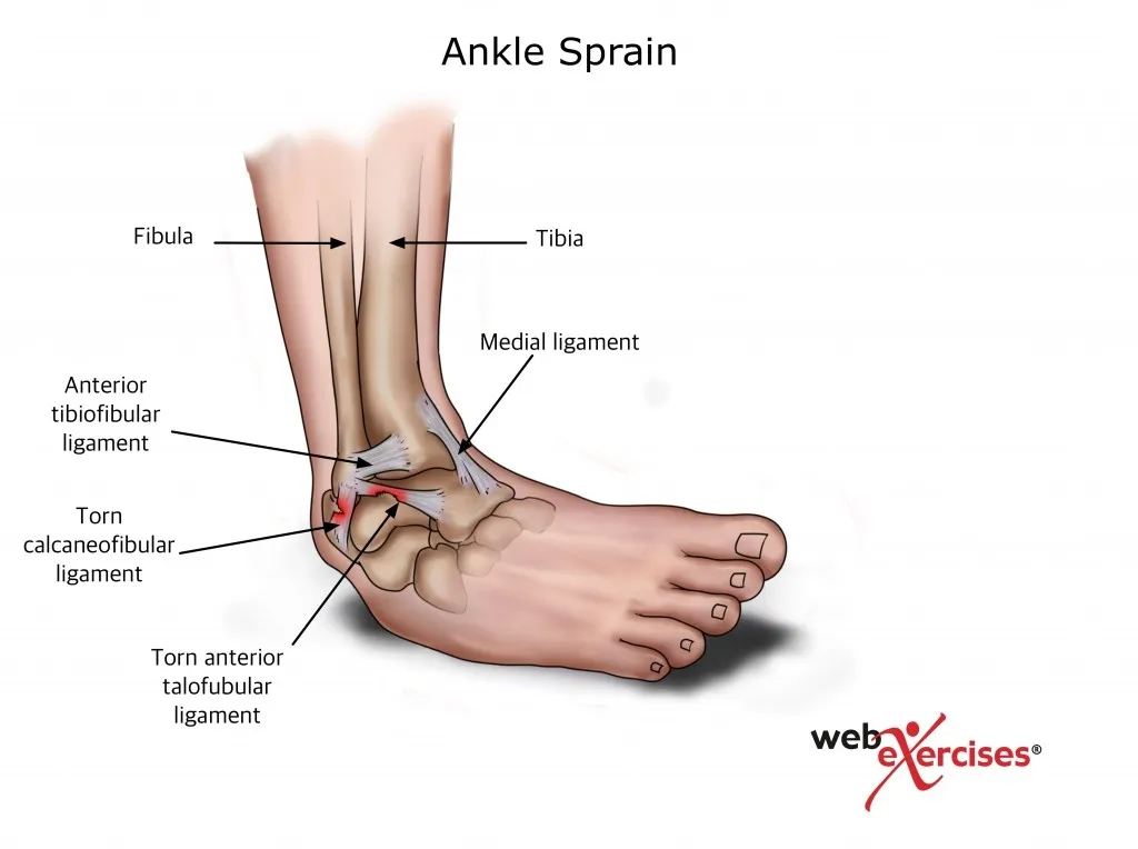 ANKLE SPRAIN