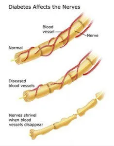 DIABETIC NEUROPATHY